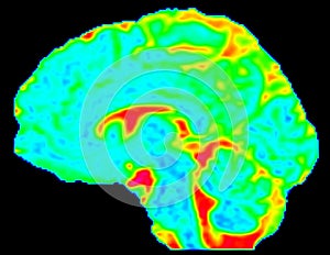 Mean Diffusivity Brain Map in Sagittal View photo