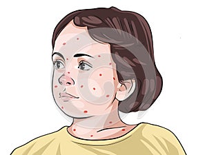 Measles is a highly contagious infectious disease caused by the measles virus