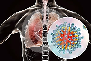 Measles viruses in human respiratory system photo