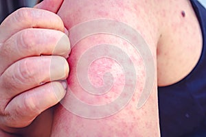 Measles, Women scratch the upper arm with one hand due to the numerous red pruritus.