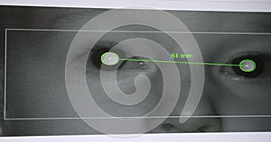 Measurement of interpupillary distance view from screen of ophthalmic equipment in ophthalmic clinic. Vision problems
