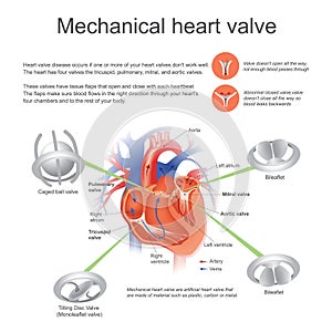 Mechanical heart valve. Vector, Illustration Design.