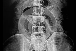 mechanical small bowel obstruction