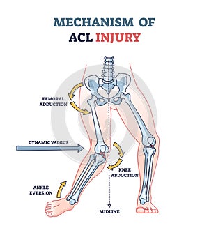 Mechanism of ACL injury as knee trauma anatomical explanation outline diagram