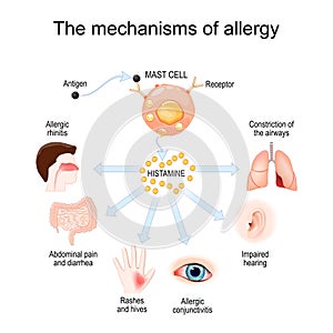 Mechanism of allergy. Mast cells and allergic reaction. Histamine