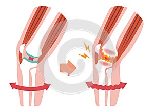 Mechanism and causes of knee joint pain / no text