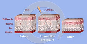 Mechanism of liposuction. Suction-assisted liposuction. photo