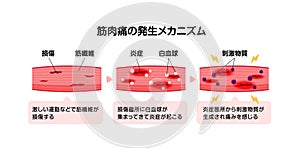 Mechanism of muscle soreness vector illustration