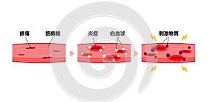 Mechanism of muscle soreness vector illustration