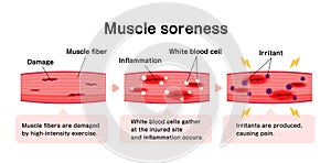 Mechanism of muscle soreness vector illustration