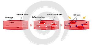 Mechanism of muscle soreness vector illustration