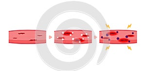 Mechanism of muscle soreness vector illustration