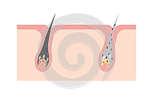 Mechanism of pigmented hair and gray hair / comparison vector illustration / no text