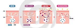 Mechanism of shingles ( herpes zoster ) vector illustration (including postherpetic neuralgia photo