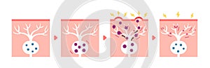 Mechanism of shingles ( herpes zoster ) vector illustration (including postherpetic neuralgia photo