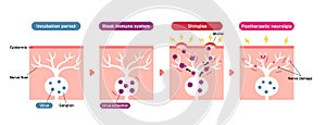 Mechanism of shingles ( herpes zoster ) vector illustration (including postherpetic neuralgia)Print photo