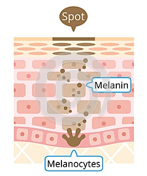 Human skin layer of melanin and facial dark spots. Infographic skin layer illustration. Beauty and skin care concept photo