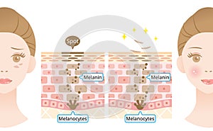 Mechanism of skin cell turnover illustration. Melanin and melanocytes in human skin layer with woman face. beauty and skin care
