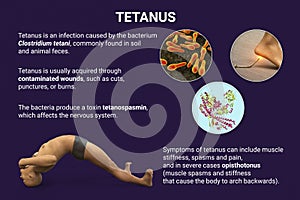 Mechanism of tetanus disease, 3D illustration