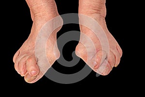 Medecin, valgus bunion, leg with deformation valgus hallux Bunion, consequence of failure of treatment, isolated on the black photo
