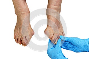 Medecin, valgus bunion, leg with deformation valgus hallux Bunion