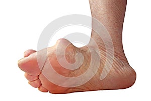 Medecin, valgus bunion, leg with deformation valgus hallux Bunion, consequence of failure of treatment, isolated on white