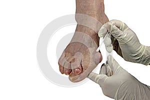 Medecin, valgus bunion, leg with deformation valgus hallux Bunion