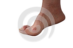 Medecin, valgus bunion, leg with deformation valgus hallux Bunion, consequence of failure of treatment, isolated on white