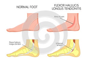 Medial ankle injury_Flexor hallucis tendonitis photo