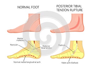Medial ankle injury_Posterior tibial tendon rupture photo