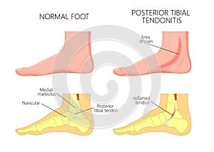 Medial ankle injury_Posterior tibial tendonitis photo