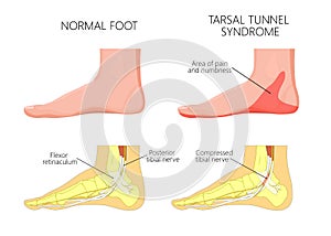 Medial ankle injury_Tarsal tunnel syndrome
