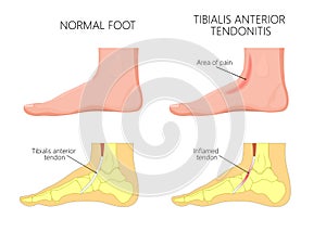 Medial ankle injury_Tibialis anterior tendonitis