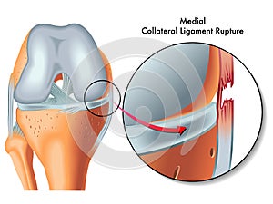 Medial collateral ligament rupture