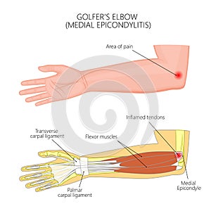 Medial Epicondylitis or golfer