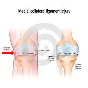 Medial knee injuries