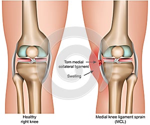 Medial knee ligament sprain medical vector illustration isolated on white background infographic