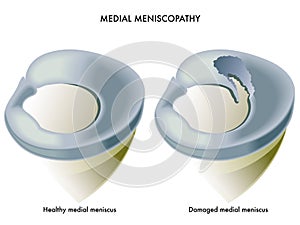 Medial meniscopathy