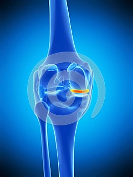 The medial meniscus photo