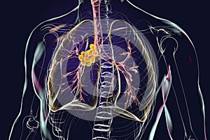 Mediastinal lymphadenitis, 3D illustration photo