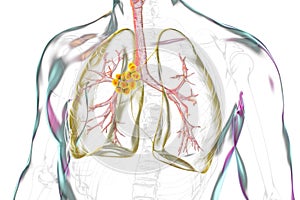 Mediastinal lymphadenitis, illustration