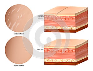 Medical Anatomy Skin Stretch Marks. Normal skin and Stretch Mark. Collagen elastin. photo