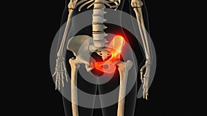 Medical animation of the hip bone pain photo