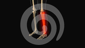 Medical animation of the tibia fibula bone pain