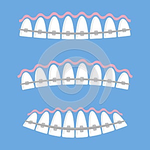 Medical Braces Teeth. Dental Care Background. Orthodontic Treatment. Cartoon Opening Mouth