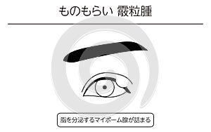 Medical Clipart, Line Drawing Illustration of Eye Disease and Sty, chalazia photo