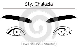 Medical Clipart, Line Drawing Illustration of Eye Disease and Sty, external hordeolum