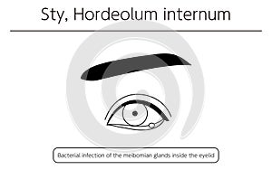 Medical Clipart, Line Drawing Illustration of Eye Disease and Sty, hordeolum internum