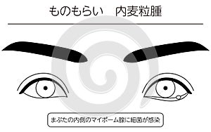 Medical Clipart, Line Drawing Illustration of Eye Disease and Sty, hordeolum internum photo
