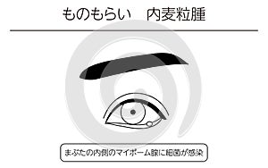 Medical Clipart, Line Drawing Illustration of Eye Disease and Sty, hordeolum internum photo